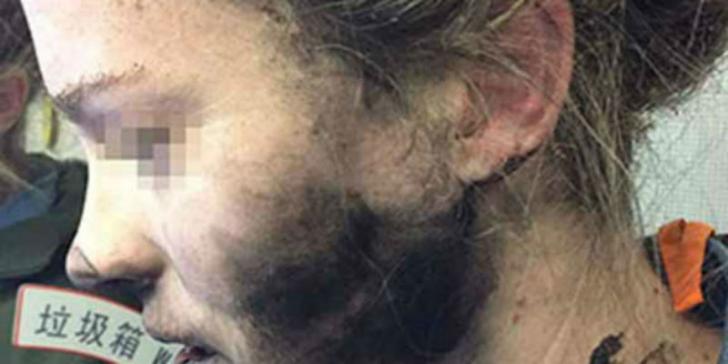 Hati-hati Gunakan Earphone, Wajah Perempuan Ini Terbakar saat Dengarkan Musik
