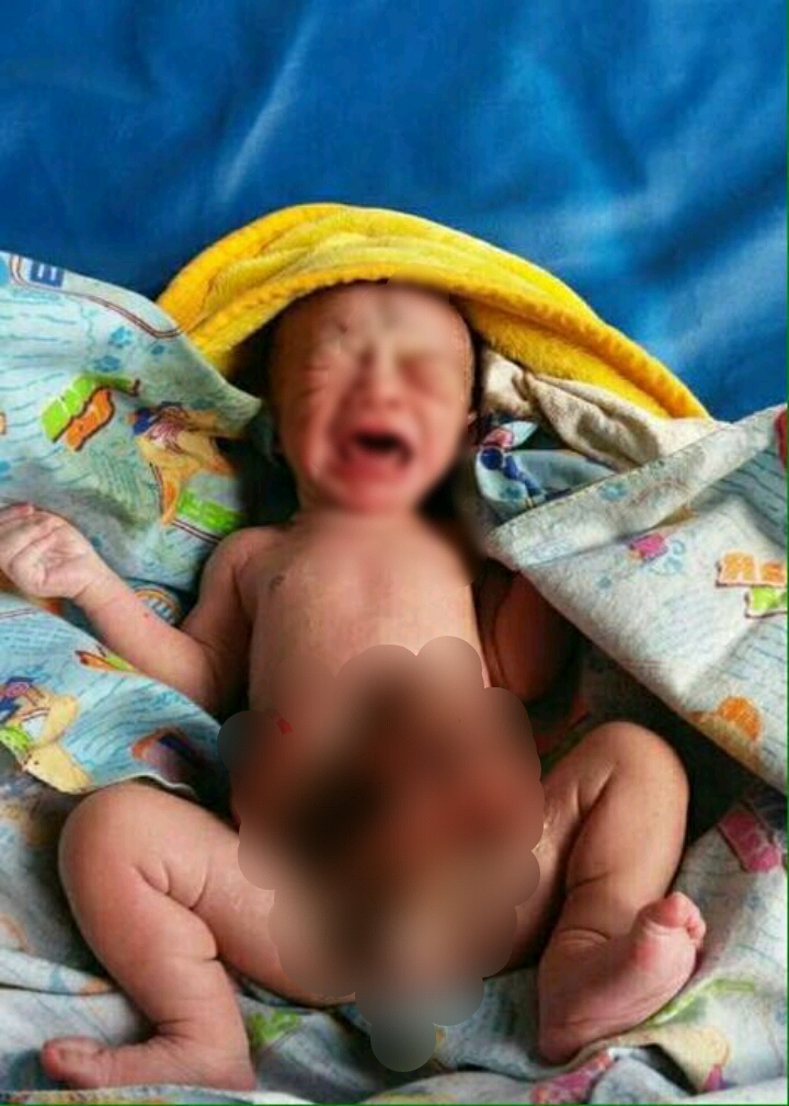 Dijenguk Wartawan, Rio Orang Tua Bayi yang Lahir di Inhil Keluar Usus Merasa Terharu